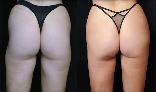 Buttocks Sculpting Body Contouring Before After Mississauga Oakville